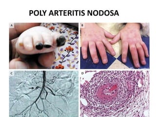 POLY ARTERITIS NODOSA
 