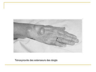 Ténosynovite des extenseurs des doigts
 