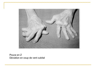 Pouce en Z
Déviation en coup de vent cubital
 