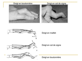 Doigt en boutonnière Doigt en col de signe
Doigt en maillet
Doigt en col de signe
Doigt en boutonnière
 