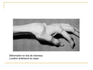 Déformation en dos de chameau
Luxation antérieure du carpe
 