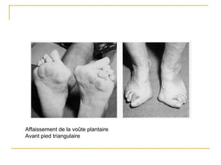 Affaissement de la voûte plantaire
Avant pied triangulaire
 
