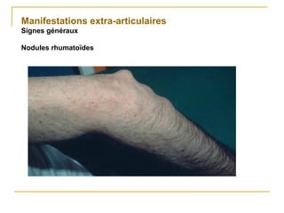 Manifestations extra-articulaires
Signes généraux
Nodules rhumatoïdes
 