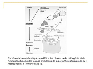 Représentation schématique des différentes phases de la pathogénie et de
l'immunopathologie des lésions articulaires de la polyarthrite rhumatoïde (M :
macrophage ; T : lymphocytes T).
 