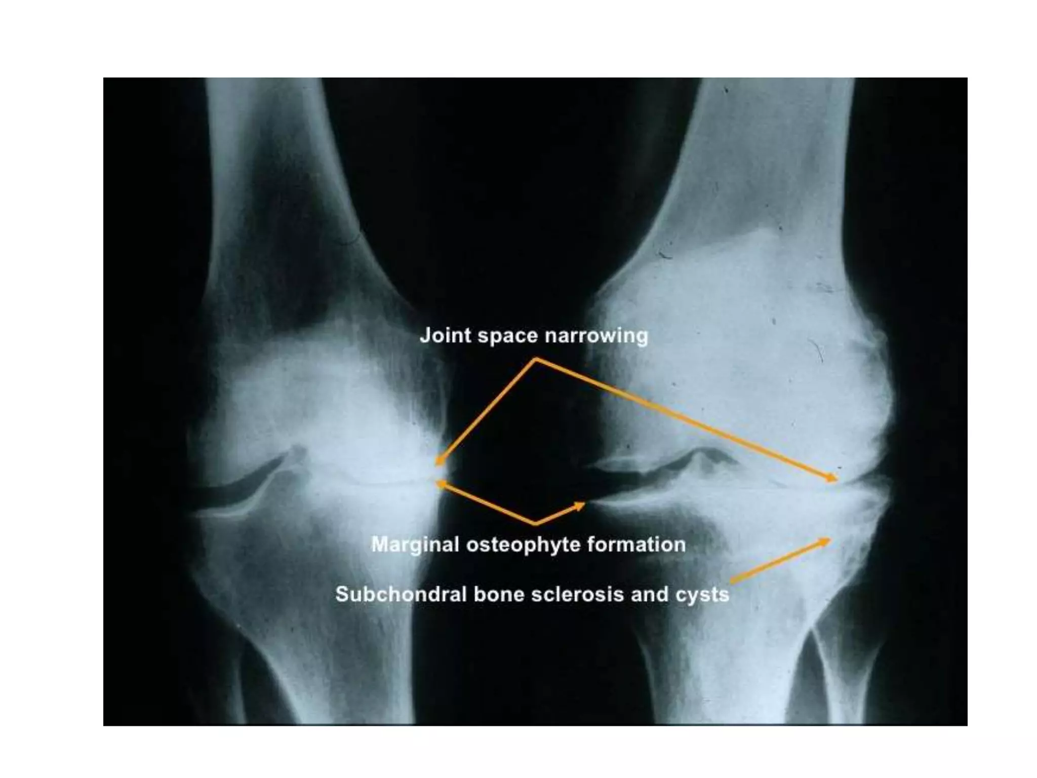 Polyarthritis (clinical approach) | PPTX