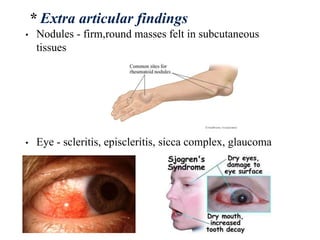 • Nodules - firm,round masses felt in subcutaneous
tissues
• Eye - scleritis, episcleritis, sicca complex, glaucoma
* Extra articular findings
 
