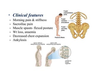 • Morning pain & stiffness
• Sacroiliac pain
• Muscle spasm- flexed posture
• Wt loss, anaemia
• Decreased chest expansion
• Ankylosis
* Clinical features
 
