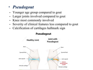• Younger age group compared to gout
• Larger joints involved compared to gout
• Knee most commonly involved
• Severity of clinical features less compared to gout
• Calcification of cartilages hallmark sign
* Pseudogout
 