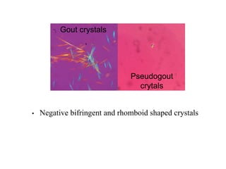 • Negative bifringent and rhomboid shaped crystals
Gout crystals
Pseudogout
crytals
 