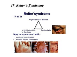 IV.Reiter’s Syndrome
 
