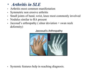 • Arthritis most common manifestation
• Symmetric non erosive arthritis
• Small joints of hand, wrist, knee most commonly involved
• Nodules similar to RA present
• Jaccoud’s arthropathy ( ulnar deviation + swan neck
deformity)
• Systemic features help in reaching diagnosis.
* Arthritis in SLE
 
