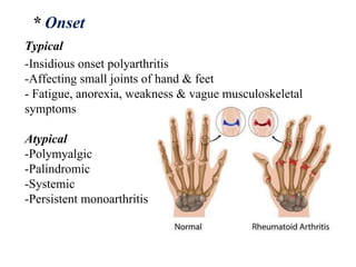 * Onset
Typical
-Insidious onset polyarthritis
-Affecting small joints of hand & feet
- Fatigue, anorexia, weakness & vague musculoskeletal
symptoms
Atypical
-Polymyalgic
-Palindromic
-Systemic
-Persistent monoarthritis
 