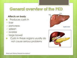 Affects on body 
 Produces cysts in 
 liver 
 pancreas 
 spleen 
 ovaries 
 large bowel 
 Cysts in these organs usually do 
not cause serious problems 
(Polycystic Kidney Disease Foundation) 
 