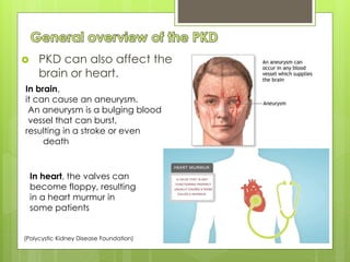  PKD can also affect the 
brain or heart. 
In brain, 
it can cause an aneurysm. 
An aneurysm is a bulging blood 
vessel that can burst, 
resulting in a stroke or even 
death 
In heart, the valves can 
become floppy, resulting 
in a heart murmur in 
some patients 
(Polycystic Kidney Disease Foundation) 
 