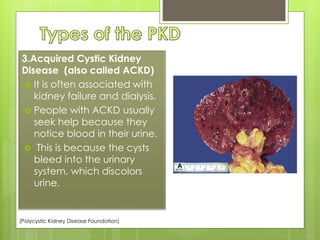 3.Acquired Cystic Kidney 
Disease (also called ACKD) 
 It is often associated with 
kidney failure and dialysis. 
 People with ACKD usually 
seek help because they 
notice blood in their urine. 
 This is because the cysts 
bleed into the urinary 
system, which discolors 
urine. 
(Polycystic Kidney Disease Foundation) 
 