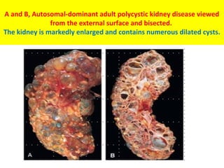 A and B, Autosomal-dominant adult polycystic kidney disease viewed
from the external surface and bisected.
The kidney is markedly enlarged and contains numerous dilated cysts.
 