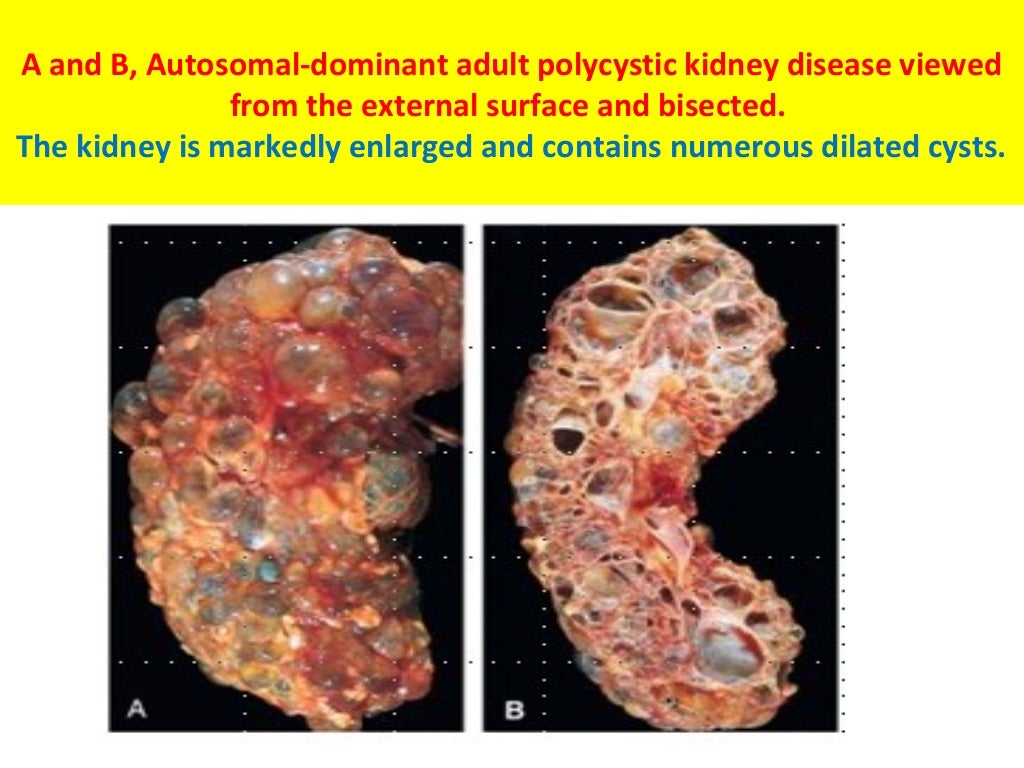 new research about polycystic kidney disease