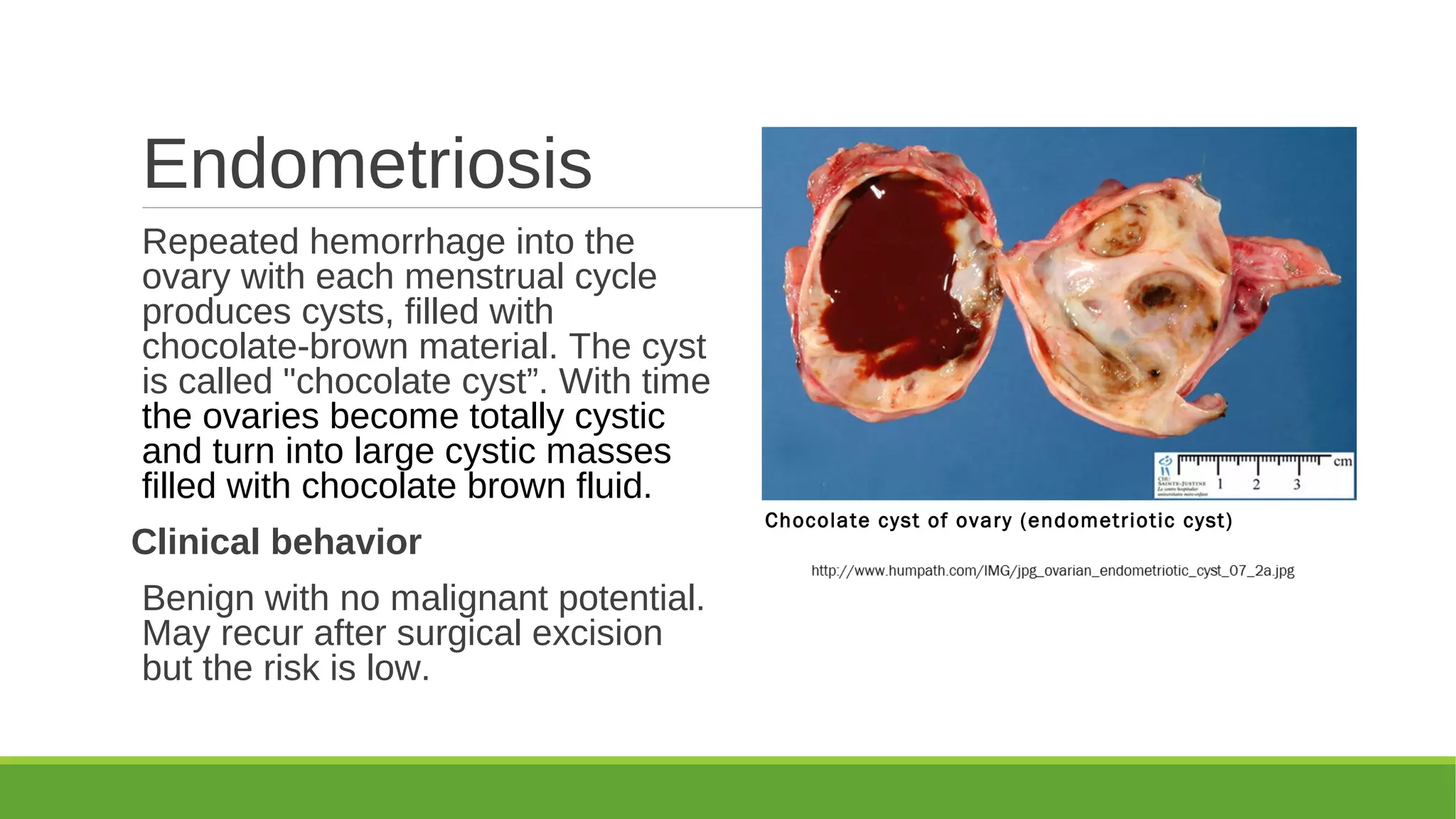 Pathology of Polycystic ovarian disease and endometriosis 2018 sufia ...