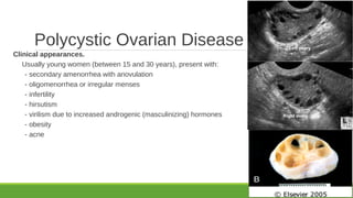 Pathology of Polycystic ovarian disease and endometriosis 2018 sufia ...