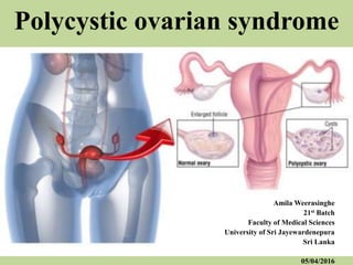 Polycystic ovarian syndrome
Amila Weerasinghe
21st Batch
Faculty of Medical Sciences
University of Sri Jayewardenepura
Sri Lanka
05/04/2016
 