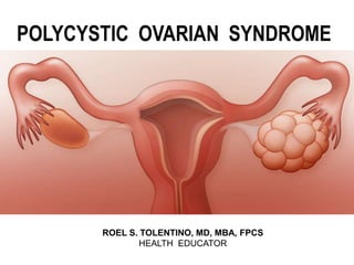 POLYCYSTIC OVARIAN SYNDROME
ROEL S. TOLENTINO, MD, MBA, FPCS
HEALTH EDUCATOR
 