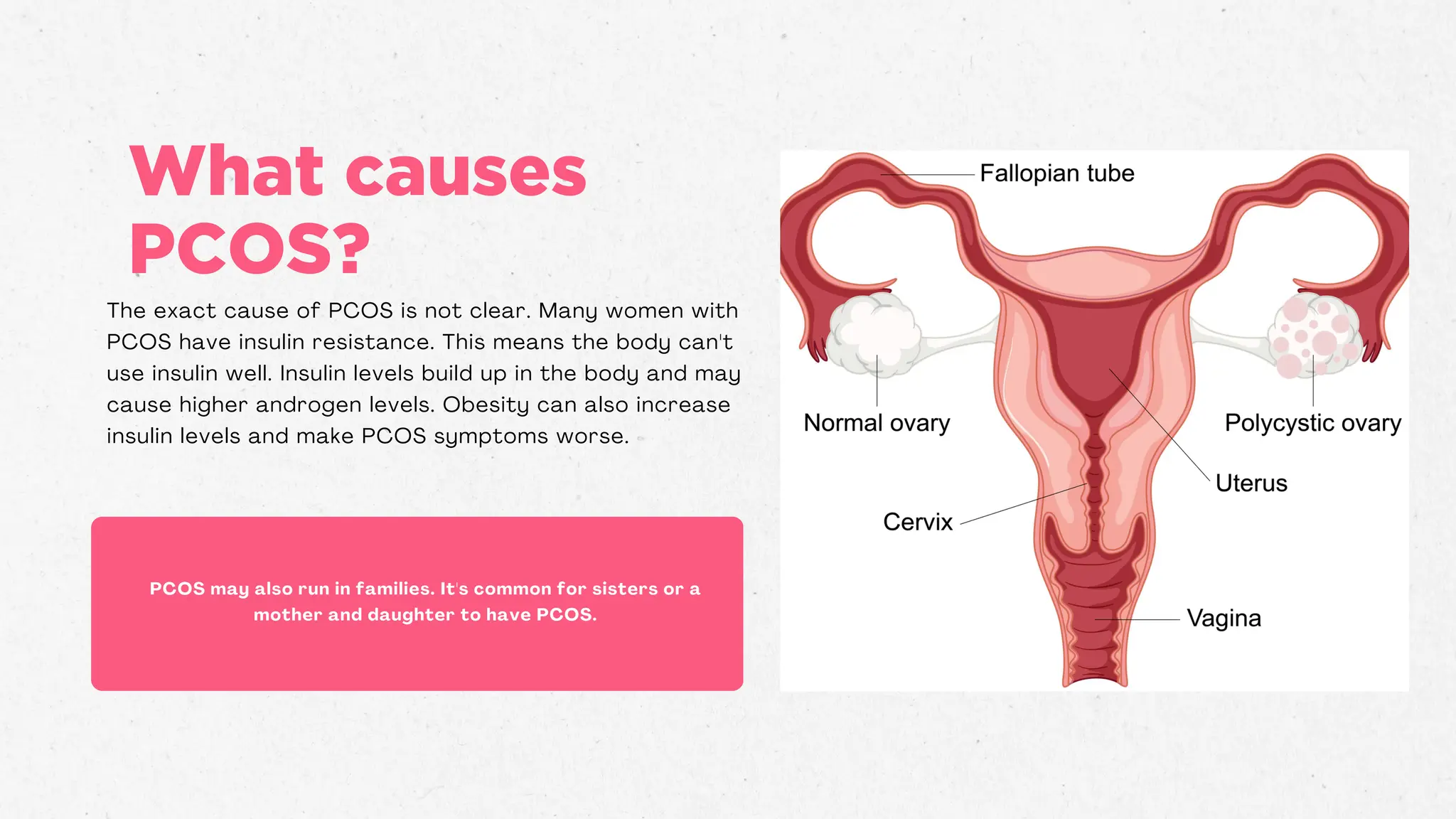 Polycystic Ovary Syndrome (PCOS) ALL.pdf