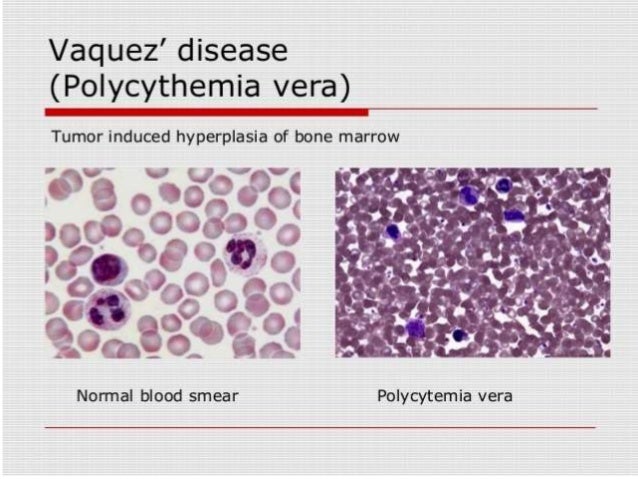 Hydroxyurea Polycythemia Rubra Vera