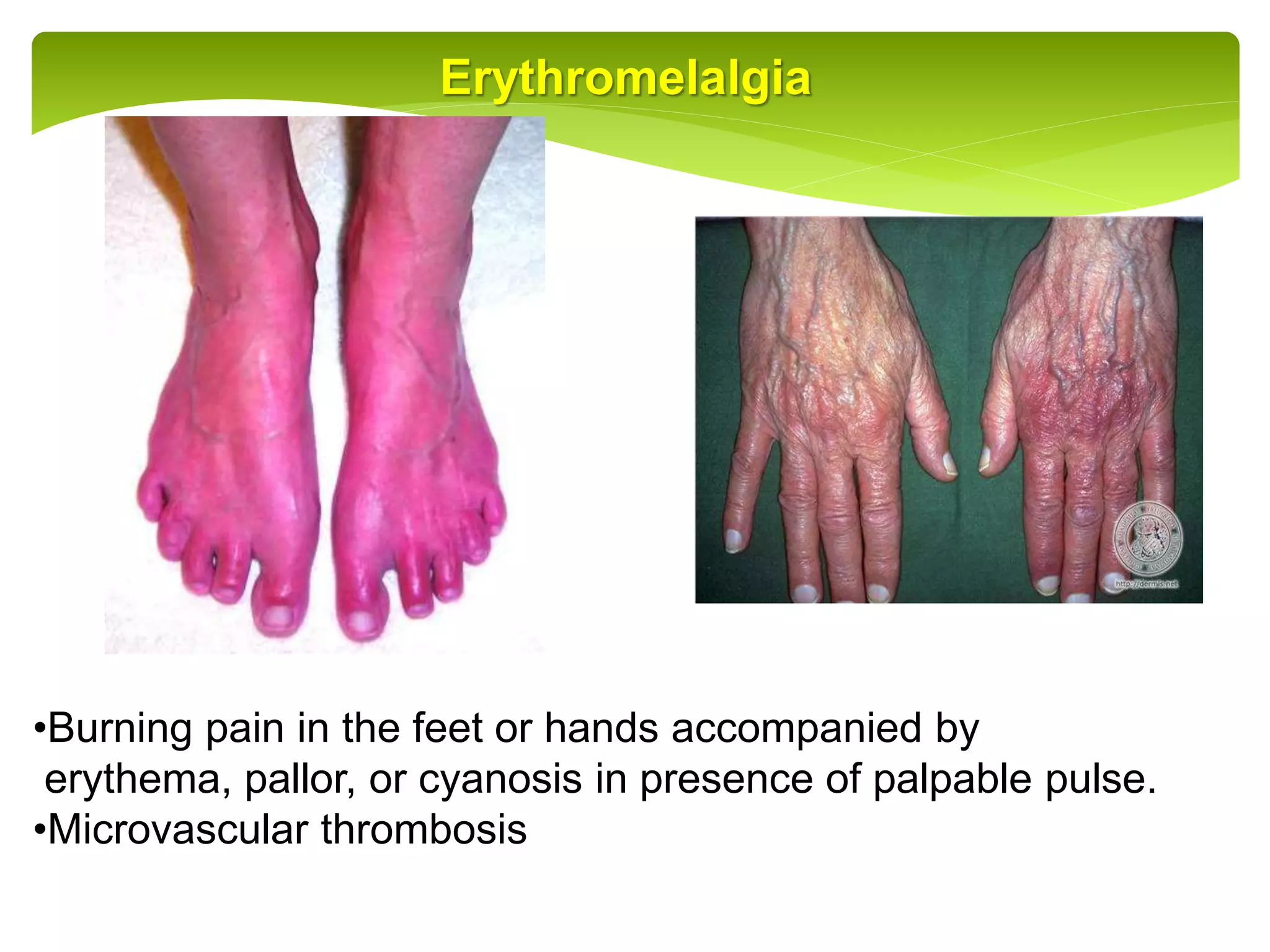 Polyscythemia Rash Polycythemia. | PPT