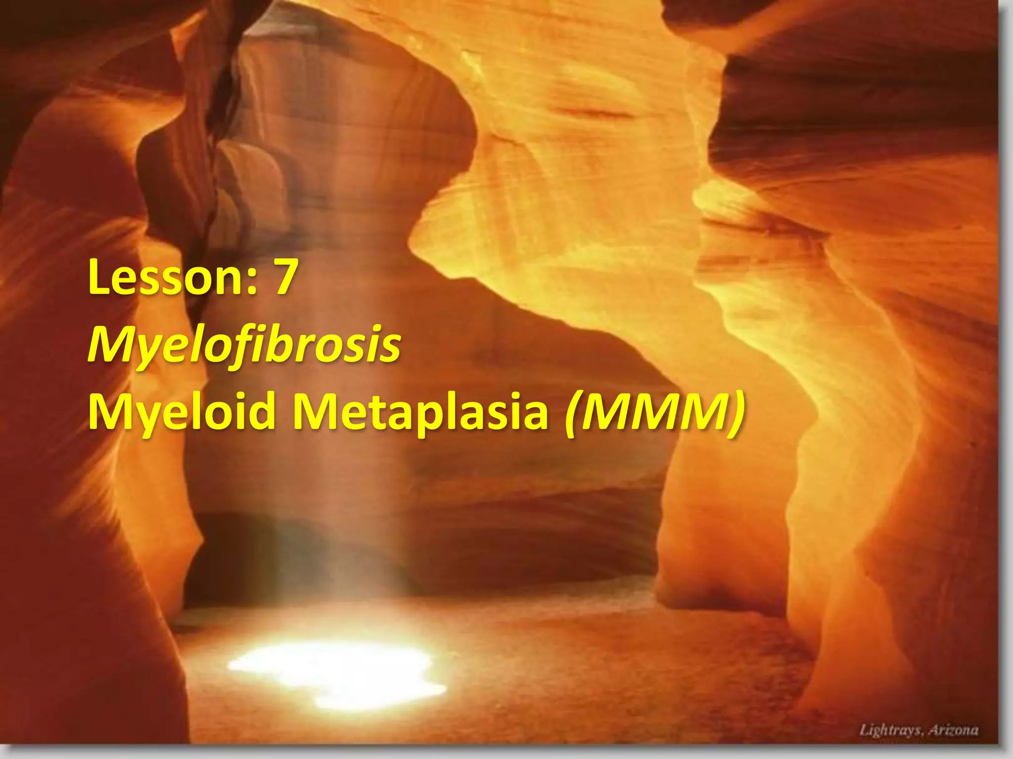 Lesson: 7
Myelofibrosis
Myeloid Metaplasia (MMM)
 