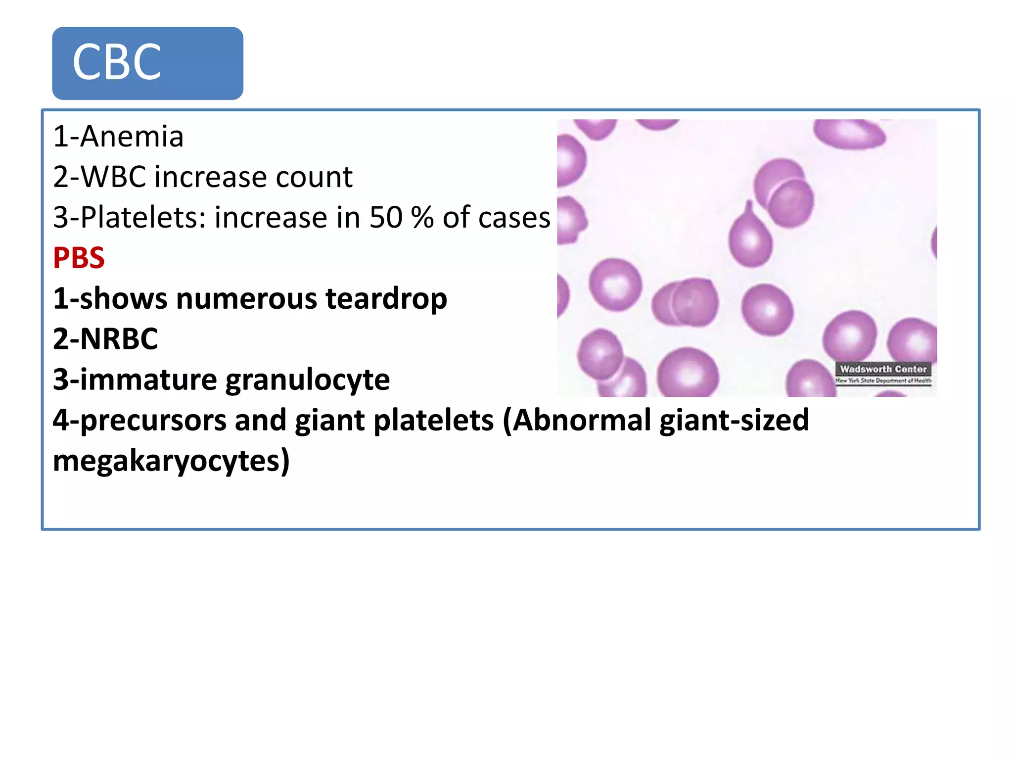 CBC
1-Anemia
2-WBC increase count
3-Platelets: increase in 50 % of cases
PBS
1-shows numerous teardrop
2-NRBC
3-immature granulocyte
4-precursors and giant platelets (Abnormal giant-sized
megakaryocytes)
 
