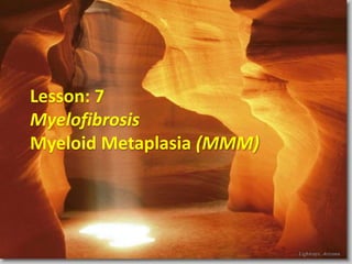Lesson: 7
Myelofibrosis
Myeloid Metaplasia (MMM)
 