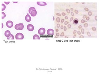 Dr.Abdulrazzaq Alagbary 2009-
2010
Tear drops NRBC and tear drops
 