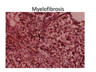 Dr.Abdulrazzaq Alagbary 2009-
2010
Myelofibrosis
 