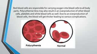 Red blood cells are responsible for carrying oxygen into blood cells to all body
parts. PolycythemiaVera may also result in an overproduction of other blood
cells, platelets and white blood cells as well. Due to an overproduction of
blood cells, the blood will get thicker leading to various complications.
 