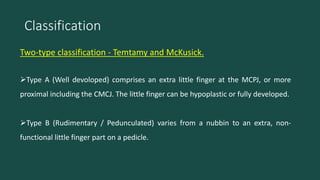 Polydactyly | PPTX