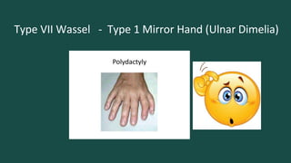 Polydactyly | PPTX