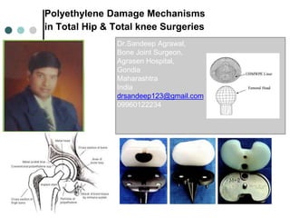 Polyethylene Damage Mechanisms 
in Total Hip & Total knee Surgeries 
Dr.Sandeep Agrawal, 
Bone Joint Surgeon, 
Agrasen Hospital, 
Gondia 
Maharashtra 
India 
drsandeep123@gmail.com 
09960122234 
 