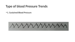 Type of blood Pressure Trends
•1. Sustained Blood Pressure
 