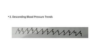 •3. Descending Blood Pressure Trends
 
