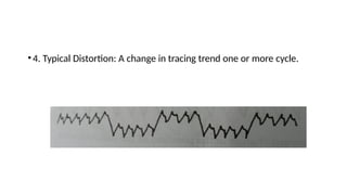 •4. Typical Distortion: A change in tracing trend one or more cycle.
 