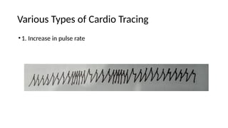Various Types of Cardio Tracing
•1. Increase in pulse rate
 
