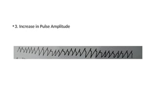 •3. Increase in Pulse Amplitude
 