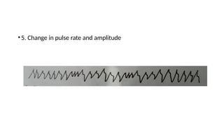 •5. Change in pulse rate and amplitude
 