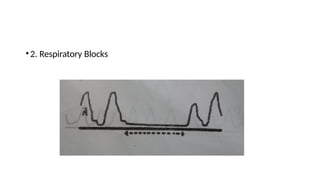 •2. Respiratory Blocks
 