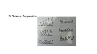 •3. Staircase Suppression
 
