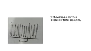 •It shows frequent cycles
because of faster breathing.
 