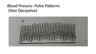 Blood Presure- Pulse Patterns
(Non Deceptive)
 