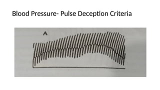 Blood Pressure- Pulse Deception Criteria
 