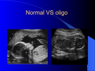 Normal VS oligo
 