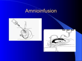 Amnioinfusion
 
